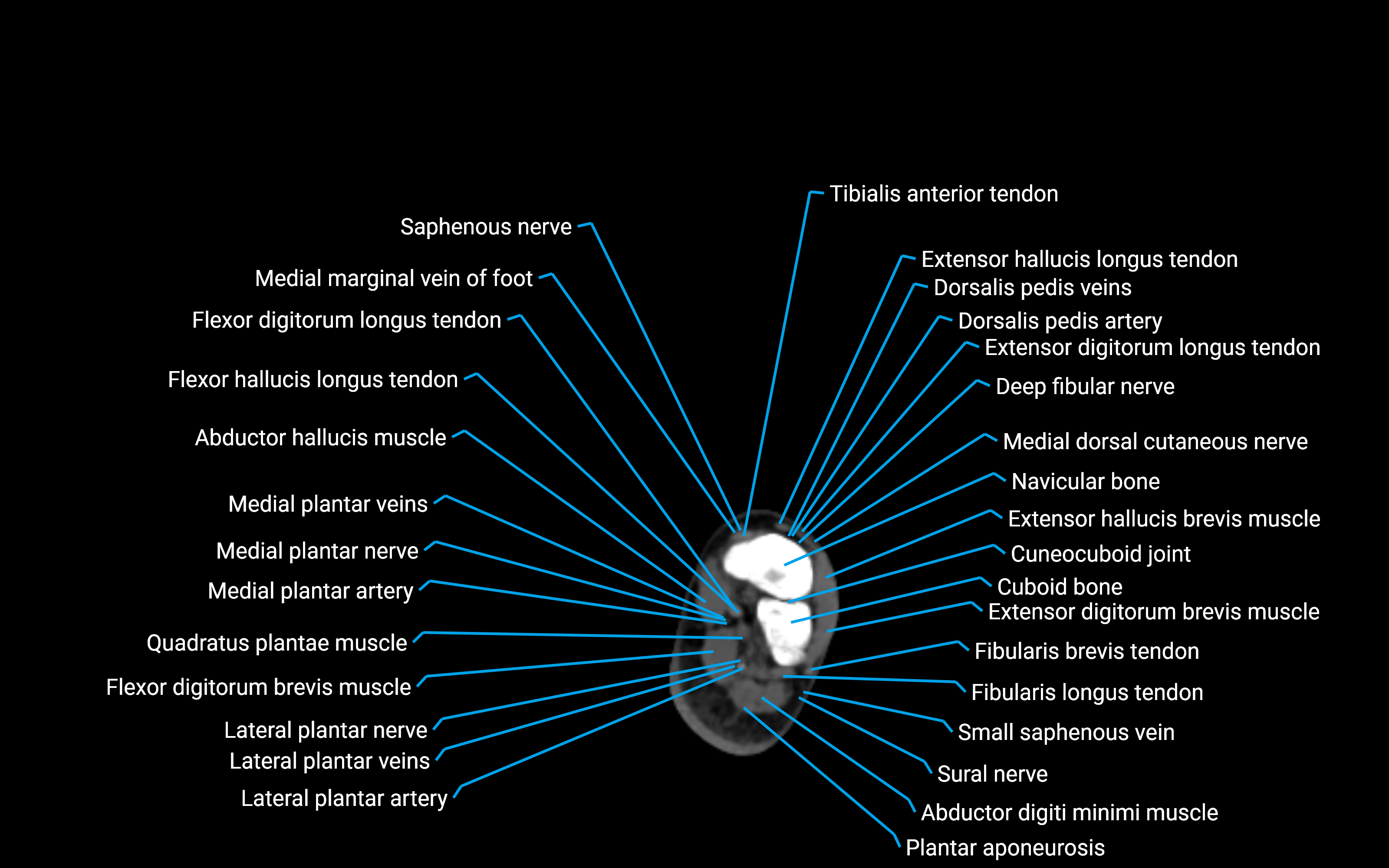 CT Lower leg axial cross sectional anatomy labelled image 177 (2).png
